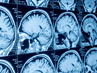 A brain scan.