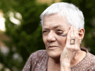 An older woman with white hair and a black eye holding her face.